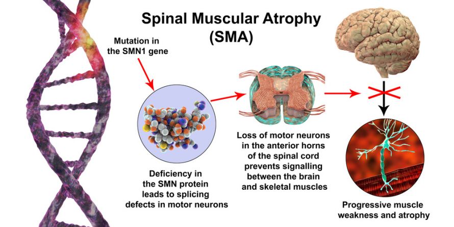 Spinale Muskelatrophie