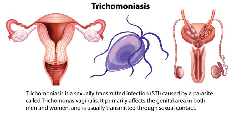 Trichomoniasis